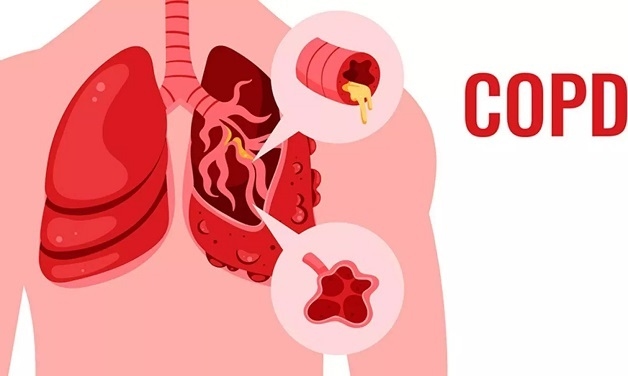 bệnh tắc nghẽn phổi mãn tính