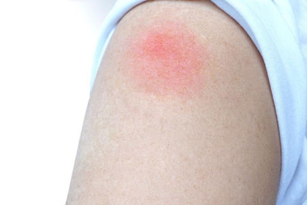 phản ứng sau tiêm