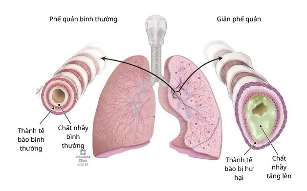 giãn phế quản