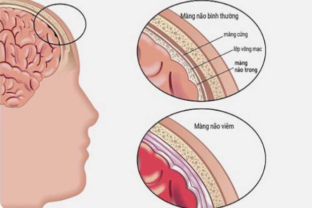 viêm màng não mủ