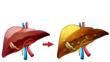 Gan nhiễm mỡ trung bình và các thông tin chi tiết