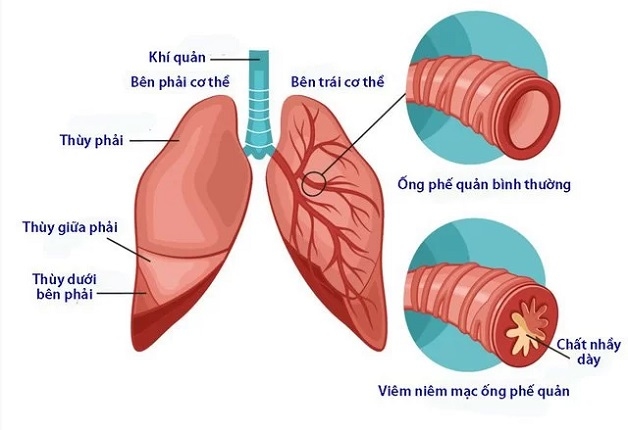 bệnh viêm phế quản