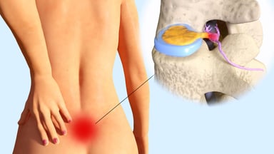 Làm rõ vấn đề thoát vị đĩa đệm có chữa được không