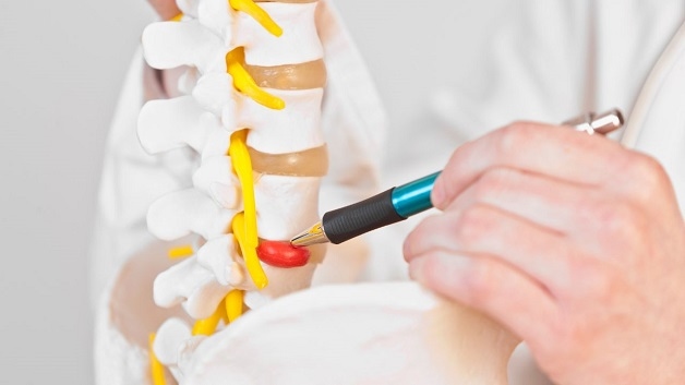 thoát vị đĩa đệm