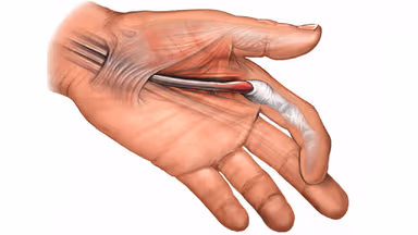 Ngón tay lò xo: Nguyên nhân, triệu chứng và cách phòng tránh