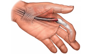 Ngón tay lò xo: Nguyên nhân, triệu chứng và cách phòng tránh