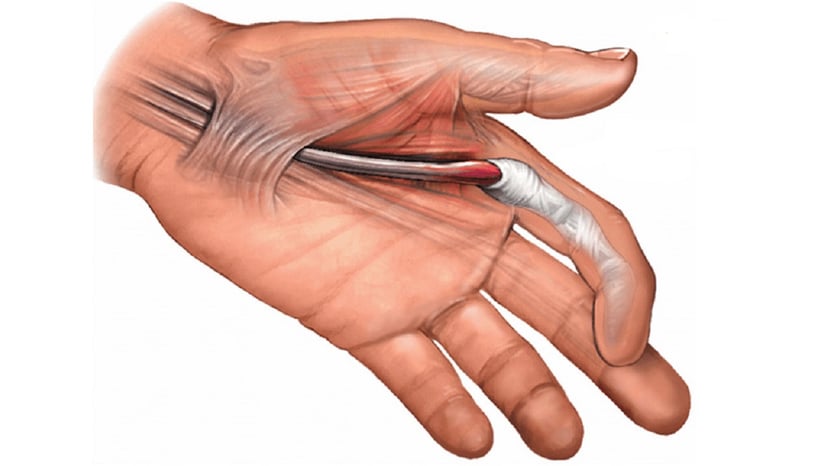 Ngón tay lò xo: Nguyên nhân, triệu chứng và cách phòng tránh