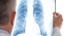 Các phương pháp chẩn đoán hình ảnh u trung thất và điều trị