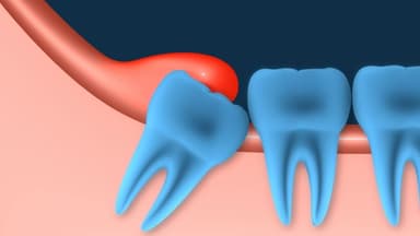 Nhổ răng khôn có nguy hiểm không và 8 nguy cơ biến chứng