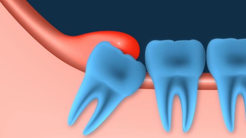 Nhổ răng khôn có nguy hiểm không và 8 nguy cơ biến chứng