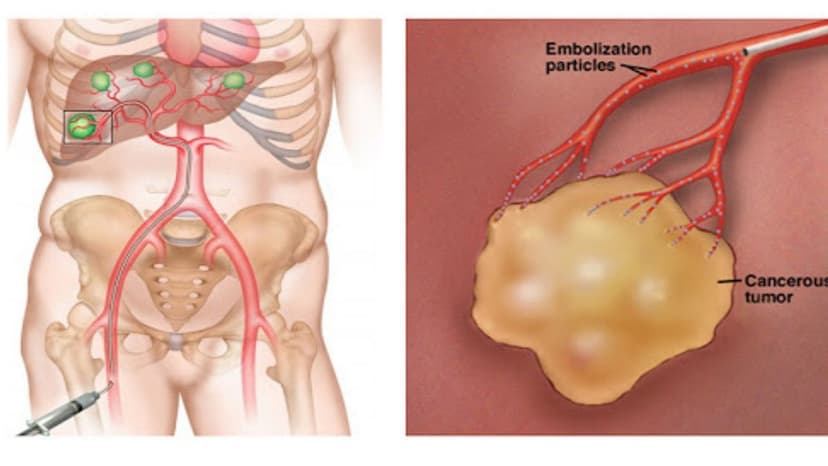 Nút mạch gan và những thông tin quan trọng cần biết