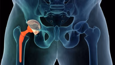 Tìm hiểu thông tin phẫu thuật thay khớp háng