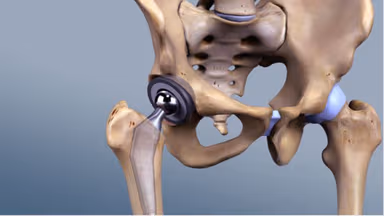 Thay khớp háng nhân tạo có độ bền trong bao lâu?