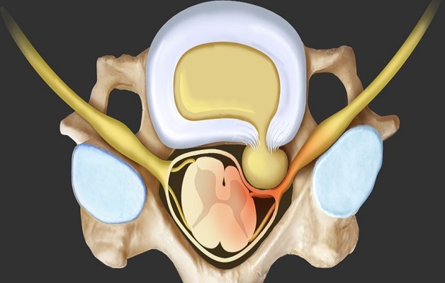 Thoát vị đĩa đệm chèn dây thần kinh là gì?