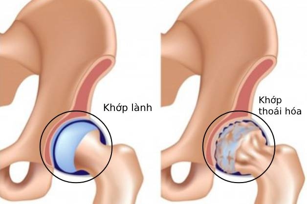 bệnh thoái hóa khớp háng