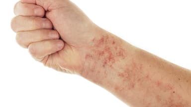 Triệu chứng ung thư máu giai đoạn đầu bạn cần biết