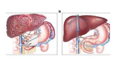 Những điều cần biết về ung thư gan huyết khối tĩnh mạch cửa