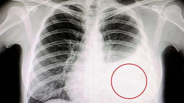Nhận biết về ung thư màng phổi