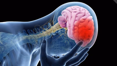 Những triệu chứng của bệnh đột quỵ thường gặp