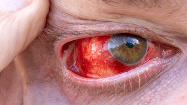 Giải đáp chi tiết: Đau mắt đỏ lây qua đâu?