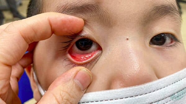 Tổng quan về đau mắt đỏ