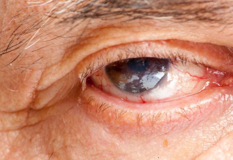 Triệu chứng của bệnh viêm màng bồ đào là gì?