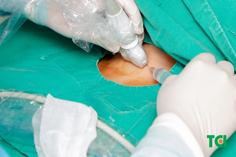 Đốt sóng cao tần u tuyến giáp nổi bật bởi khả năng điều trị không đau, thẩm mỹ.