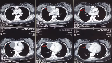 Giải đáp thắc mắc u trung thất là gì