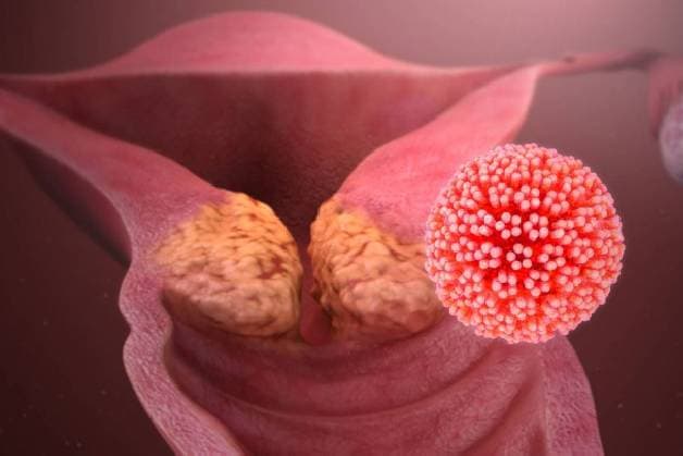 Mối liên hệ giữa virus HPV và căn bệnh ung thư cổ tử cung