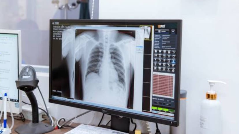 Tìm hiểu về bệnh lý hen phế quản cấp và cách phòng ngừa