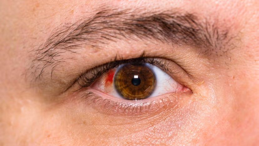 Viêm màng bồ đào trước: Những điều bạn cần biết