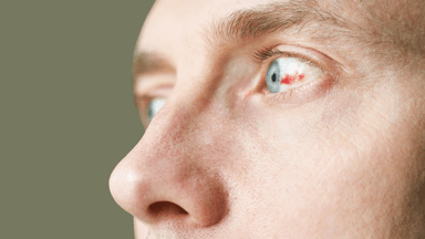 Viêm màng bồ đào: Tiềm ẩn nguy cơ mất thị lực vĩnh viễn