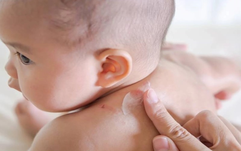thuốc bôi muỗi đốt cho bé