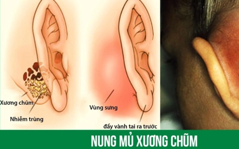 viêm tai xương chũm