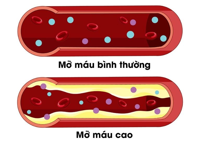 Lipanthyl 200mg được ứng dụng trong điều trị mỡ máu như thế nào?