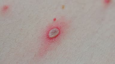 Bệnh thủy đậu ở trẻ em dưới 1 tuổi: Cẩn trọng nguy cơ tử vong