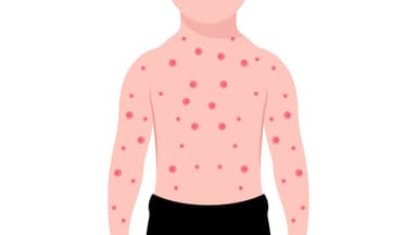 Đậu mùa: Thông tin có thể bố mẹ chưa biết