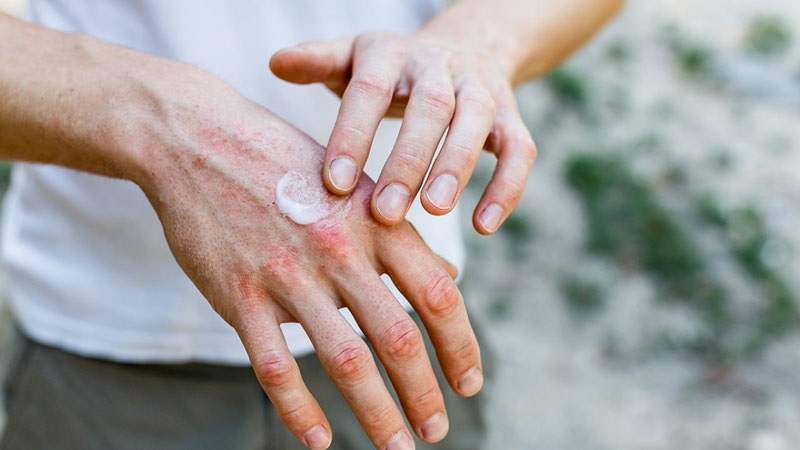 thuốc bôi viêm da dị ứng