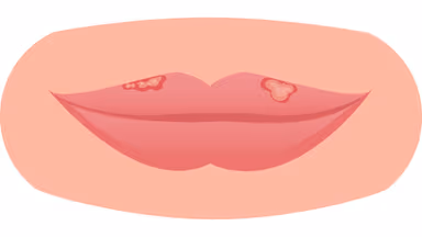 Bệnh Herpes là gì, giải đáp của chuyên gia