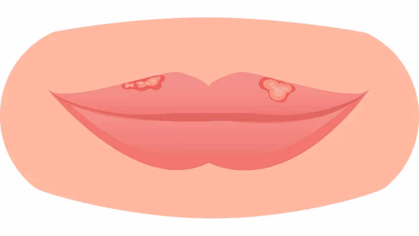 Bệnh Herpes là gì, giải đáp của chuyên gia
