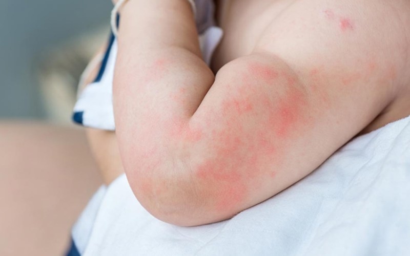trẻ bị ngứa do đâu