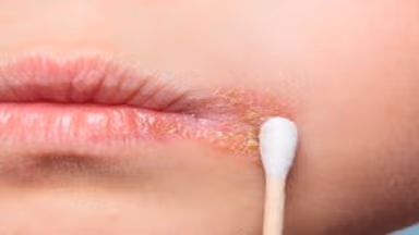 Những điều cần lưu ý về bệnh herpes ở trẻ em
