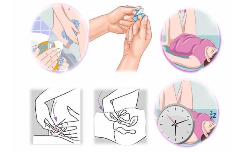 hướng dẫn đặt thuốc âm đạo