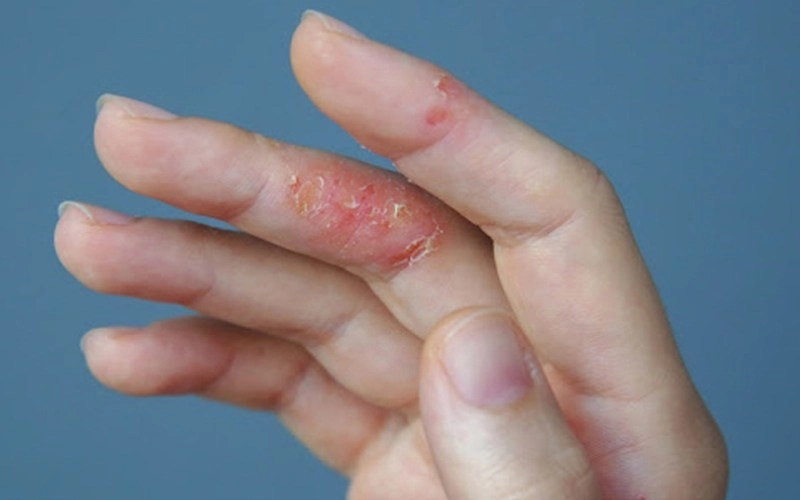 thuốc Fucicort có tác dụng gì