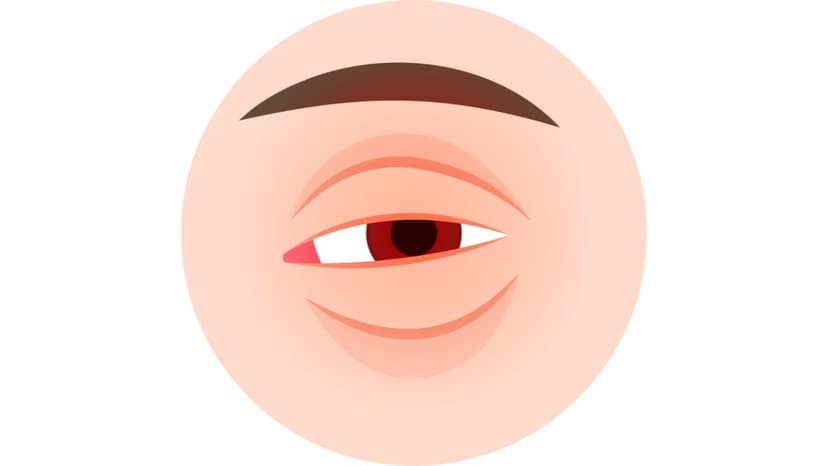 Thuốc nhỏ viêm mí mắt: 4 nhóm thường được chuyên gia chỉ định