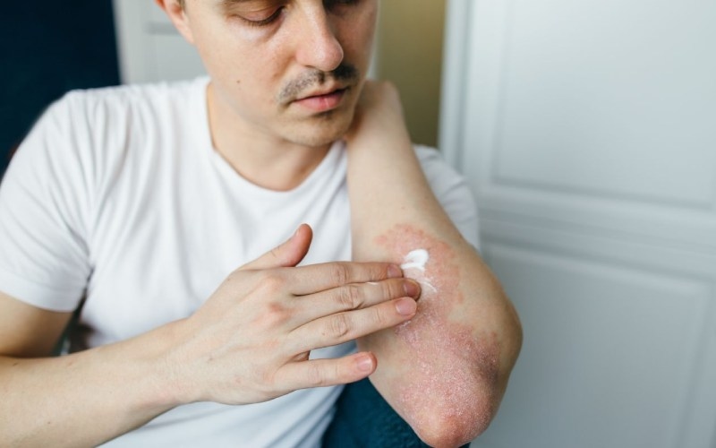 Triamcinolone có tác dụng gì