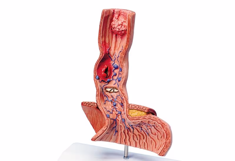 Đo HRM thực quản được thực hiện trong trường hợp nào?