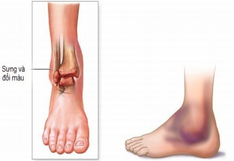 trị trật khớp bằng bó lá coi chừng biến chứng