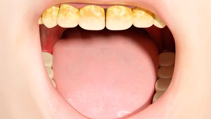 Loại bỏ cao răng tại nhà: Lợi bất cập hại