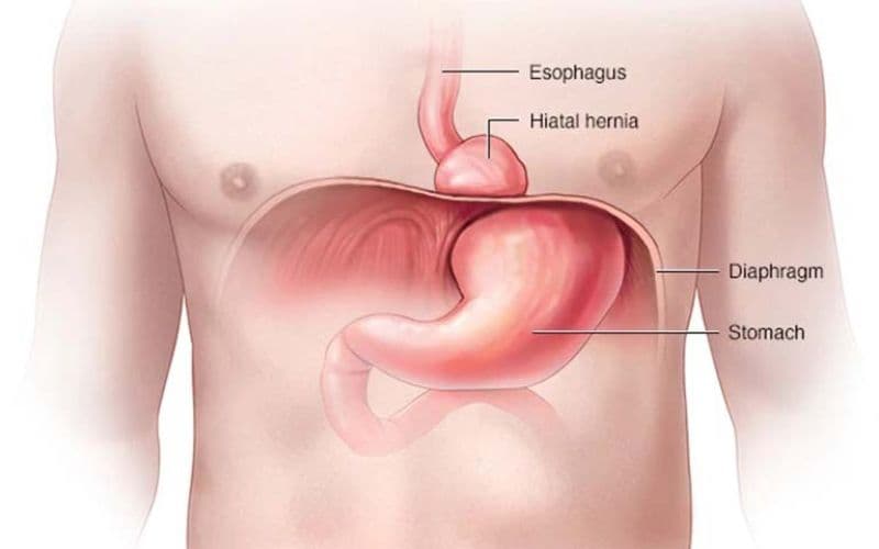 Khi cơ hoành yếu hoặc rách, axit dạ dày có thể trào ngược vào thực quản